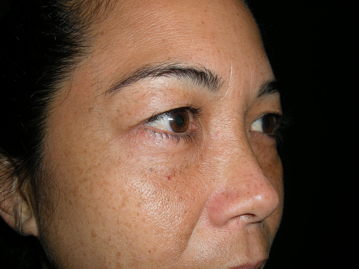 Blephroplasty Before & After