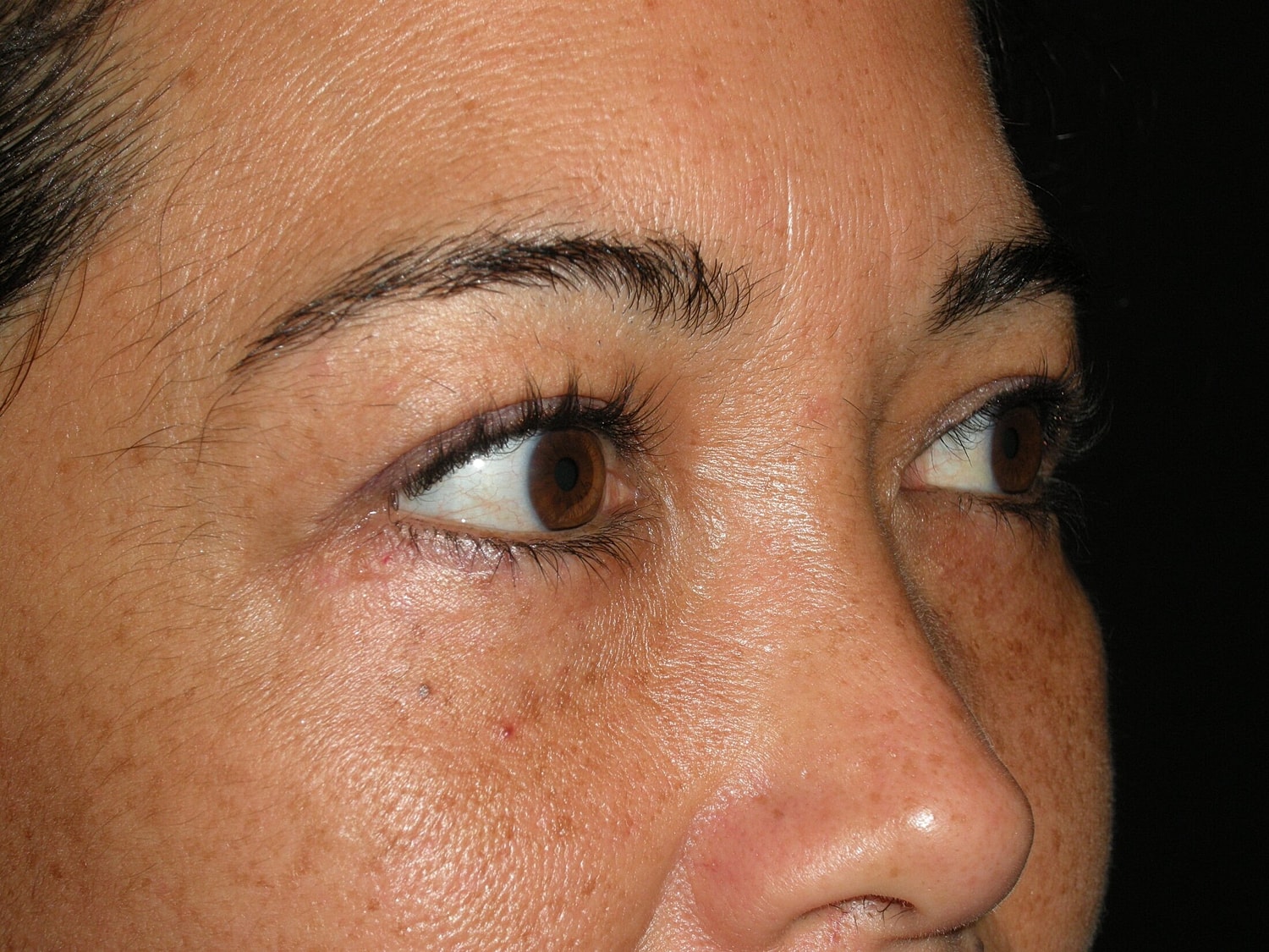 Blephroplasty Before & After