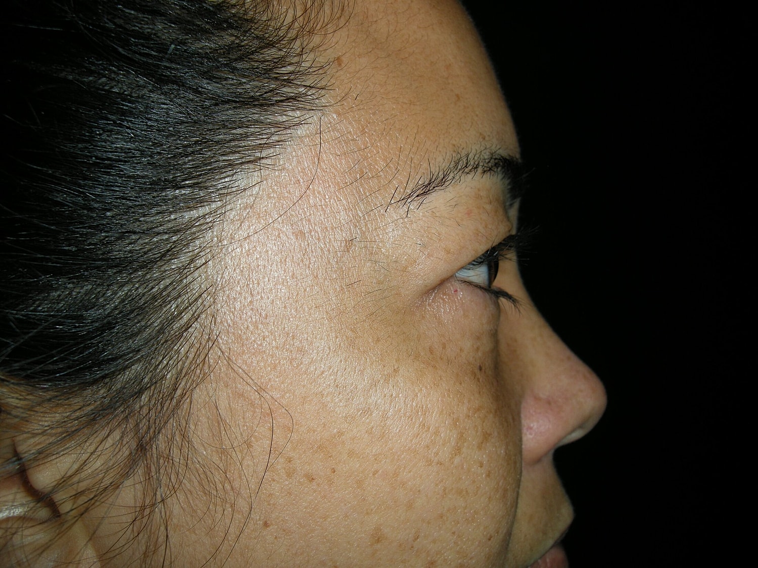 Blephroplasty Before & After