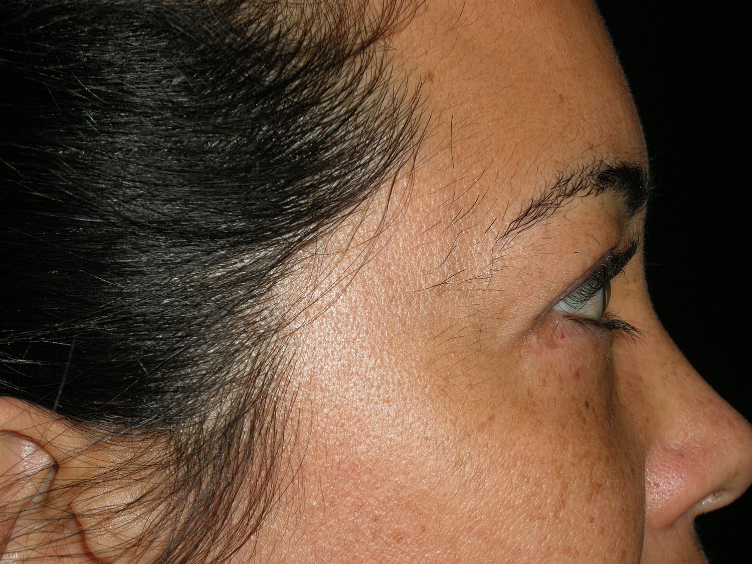 Blephroplasty Before & After