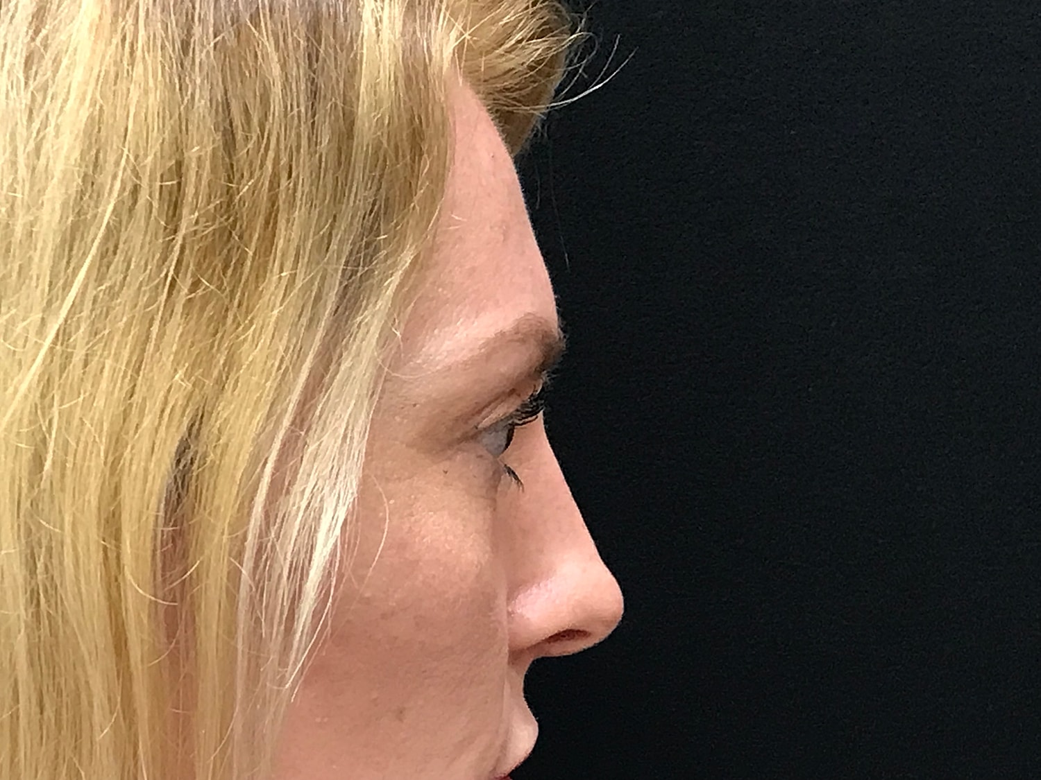 Blephroplasty [.block]Gallery[] Before & After