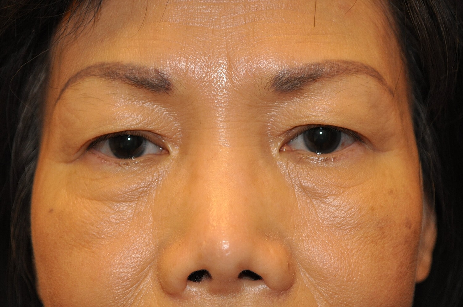 Blephroplasty Before & After