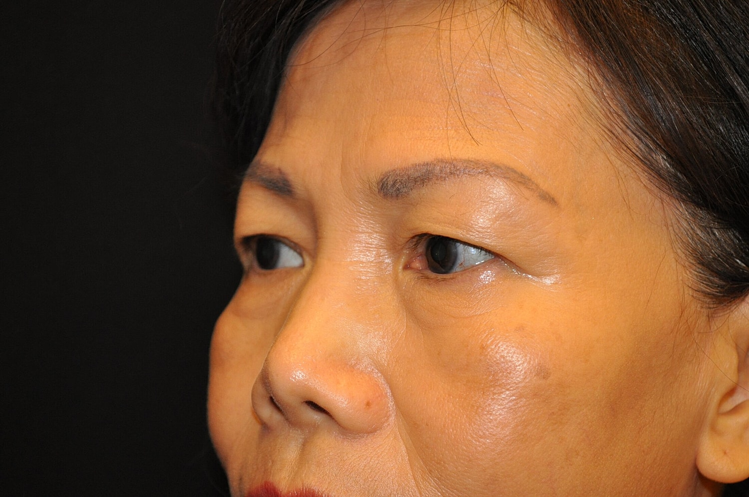 Blephroplasty Before & After