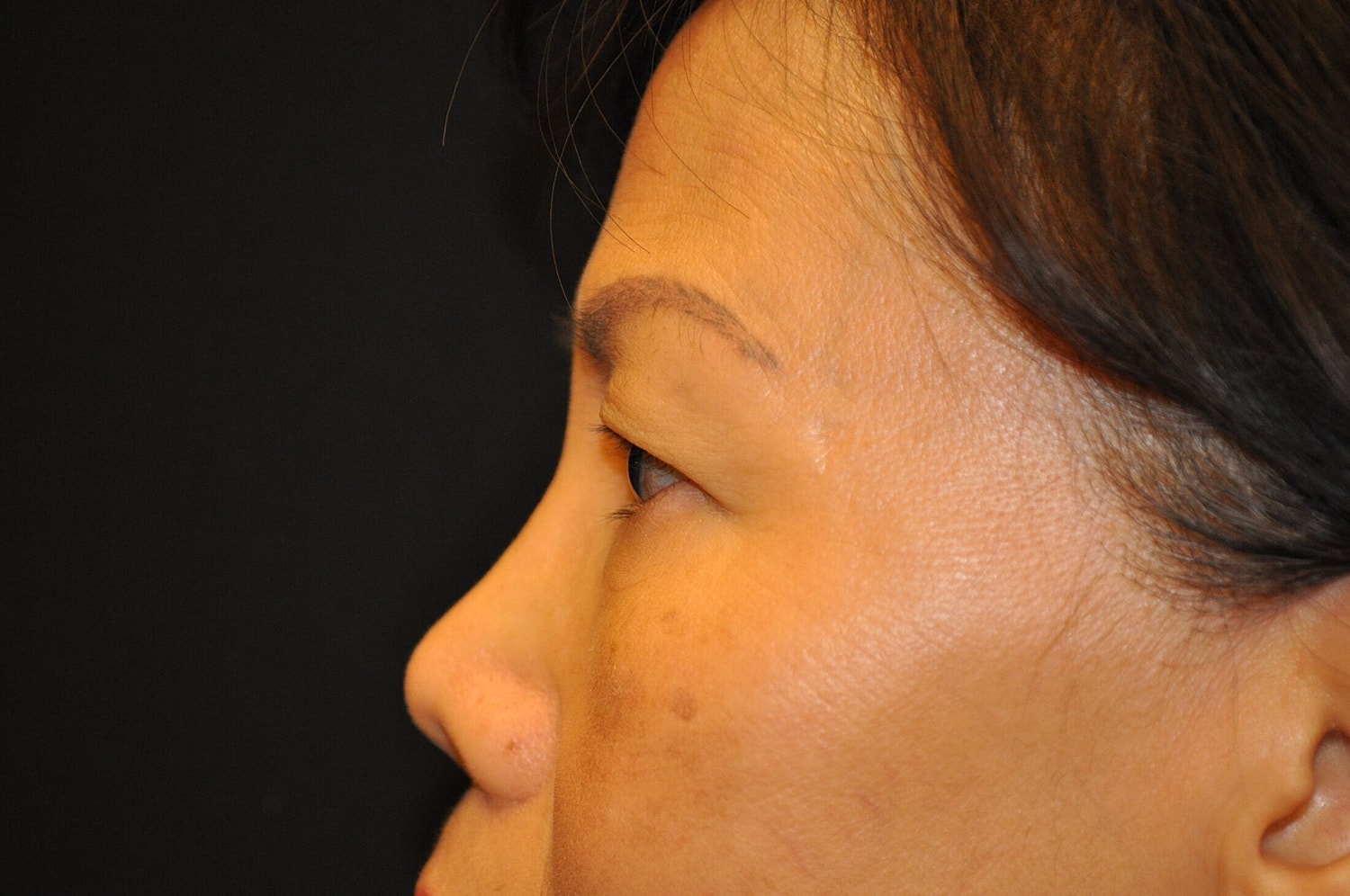 Blephroplasty Before & After