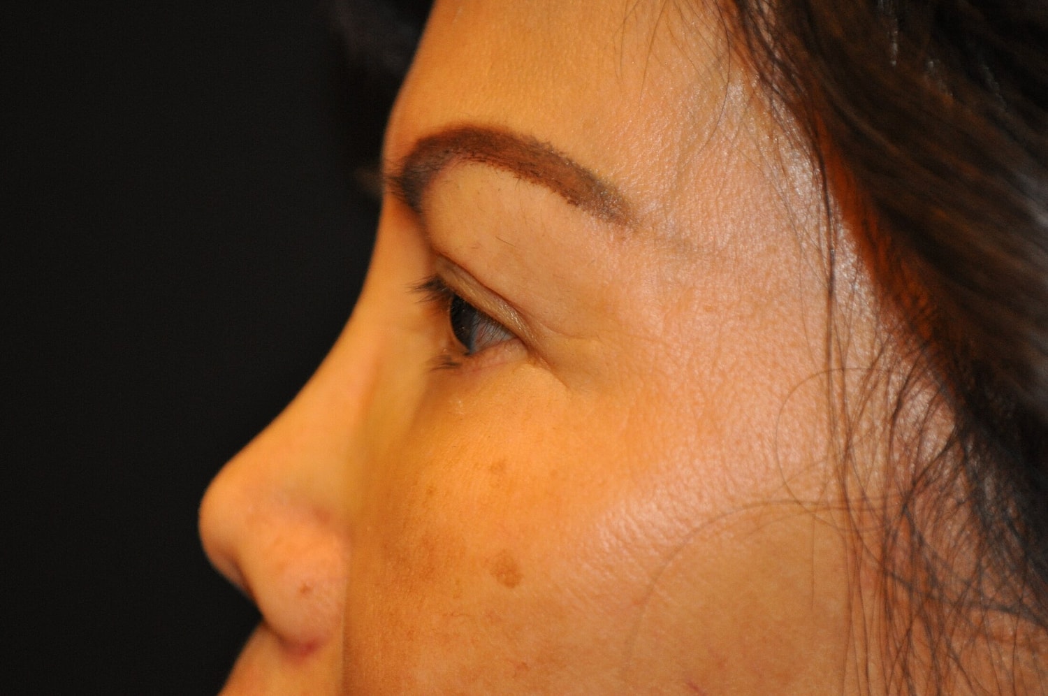 Blephroplasty Before & After