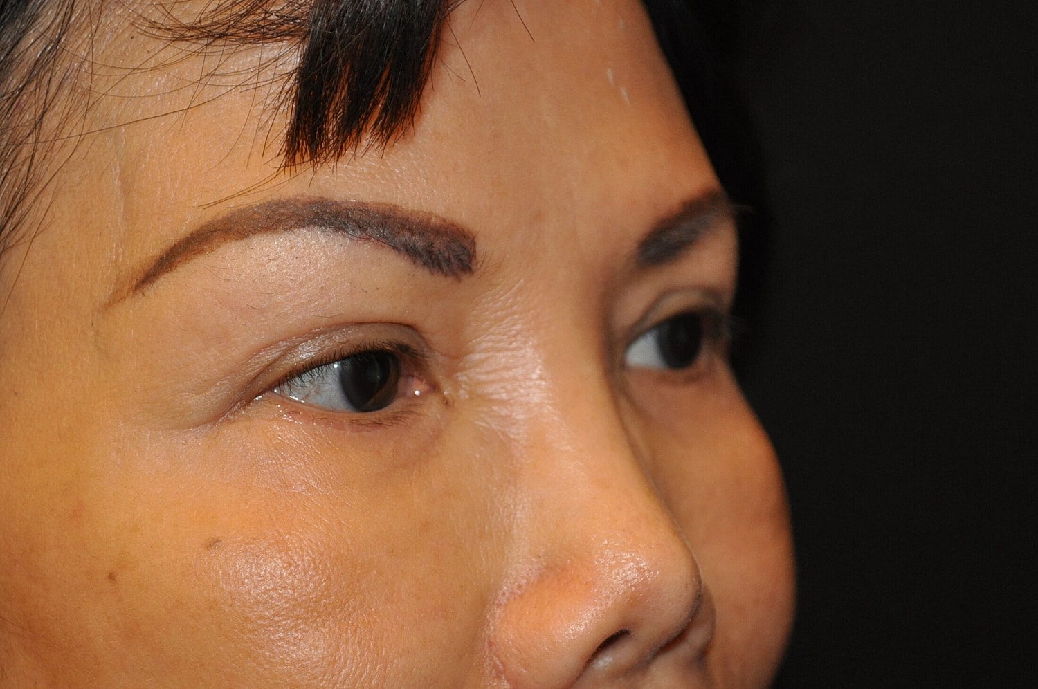 Blephroplasty Before & After