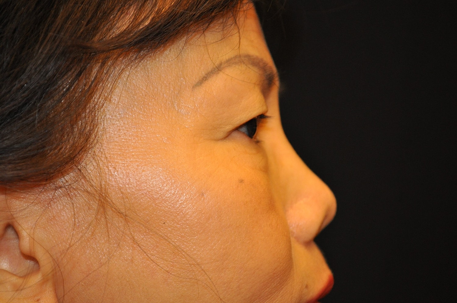 Blephroplasty Before & After