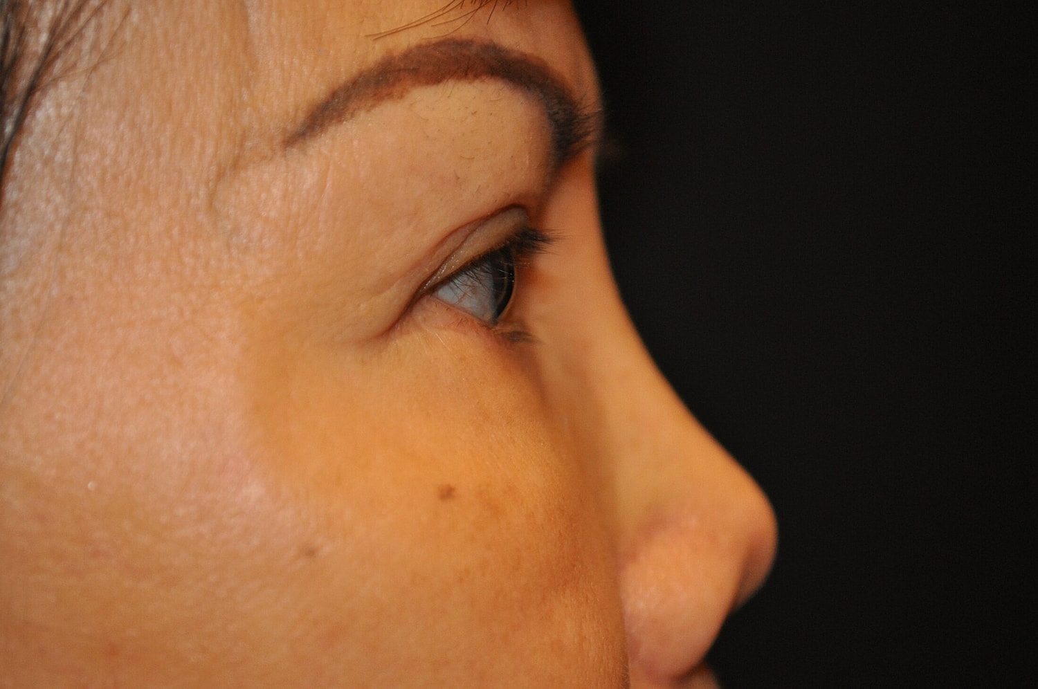 Blephroplasty Before & After