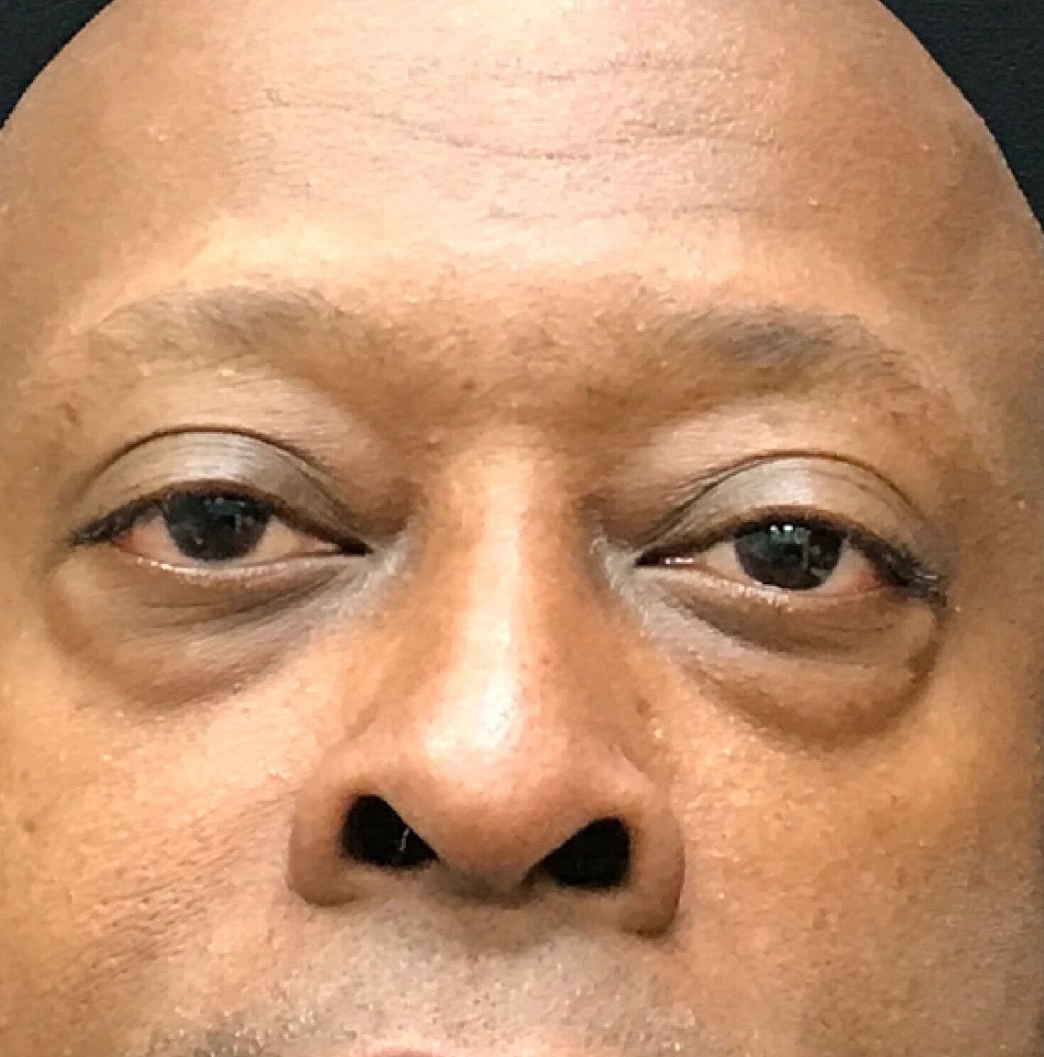 Blephroplasty Before & After