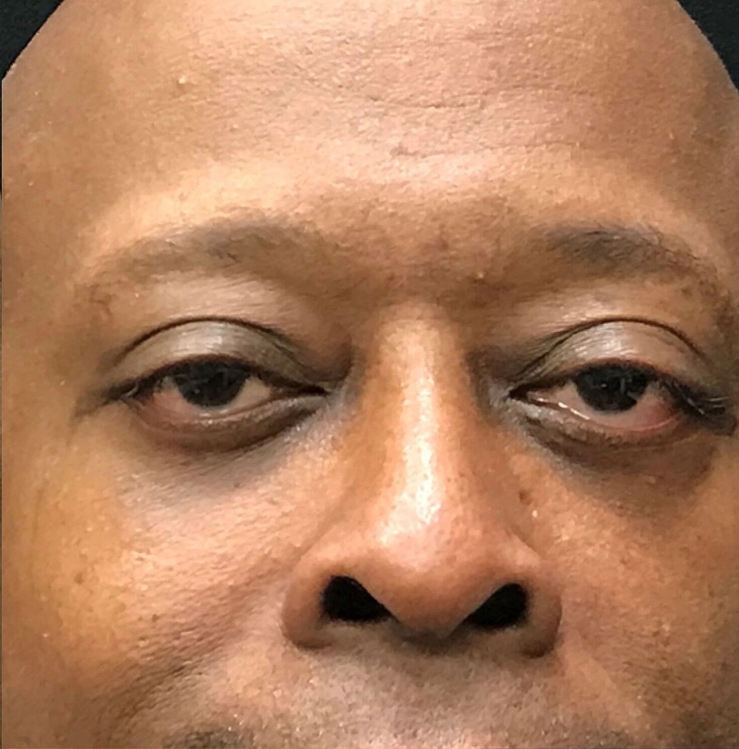 Blephroplasty Before & After