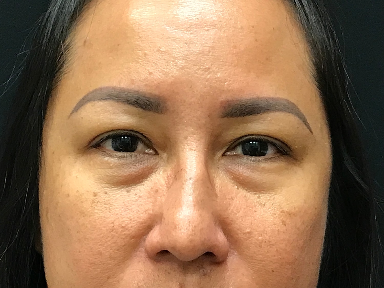 Blephroplasty [.block]Gallery[] Before & After