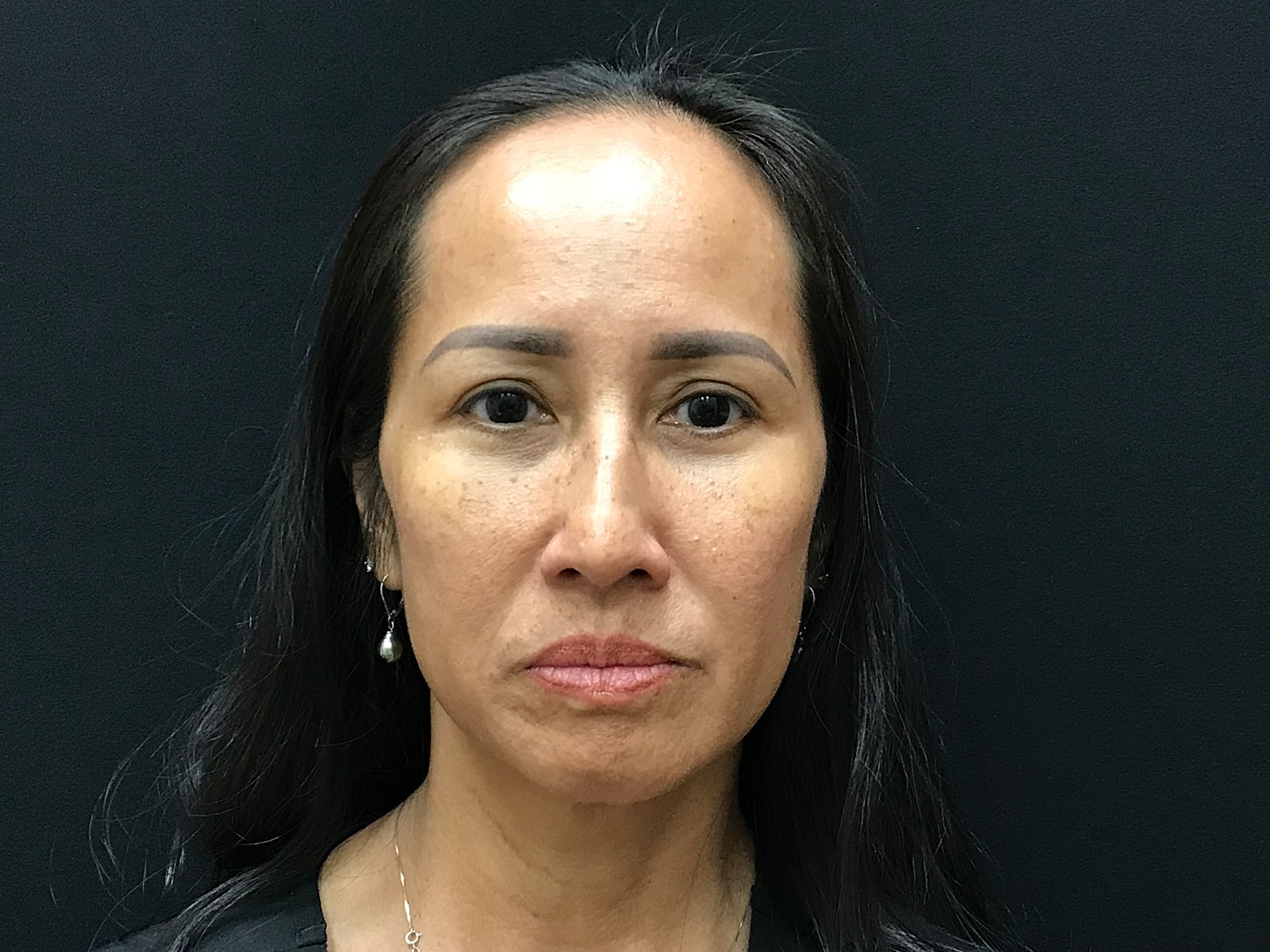 Blephroplasty [.block]Gallery[] Before & After