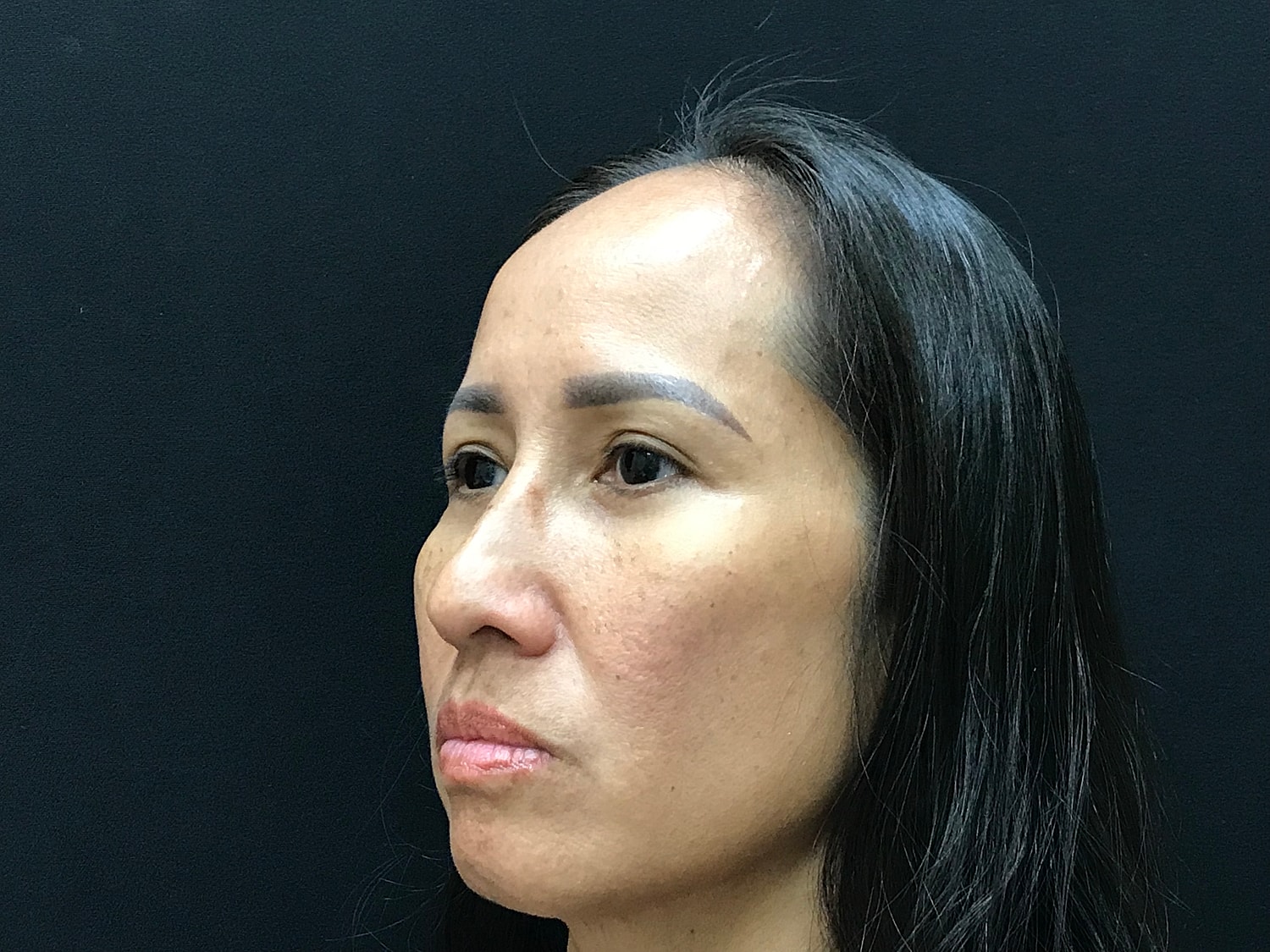 Blephroplasty [.block]Gallery[] Before & After