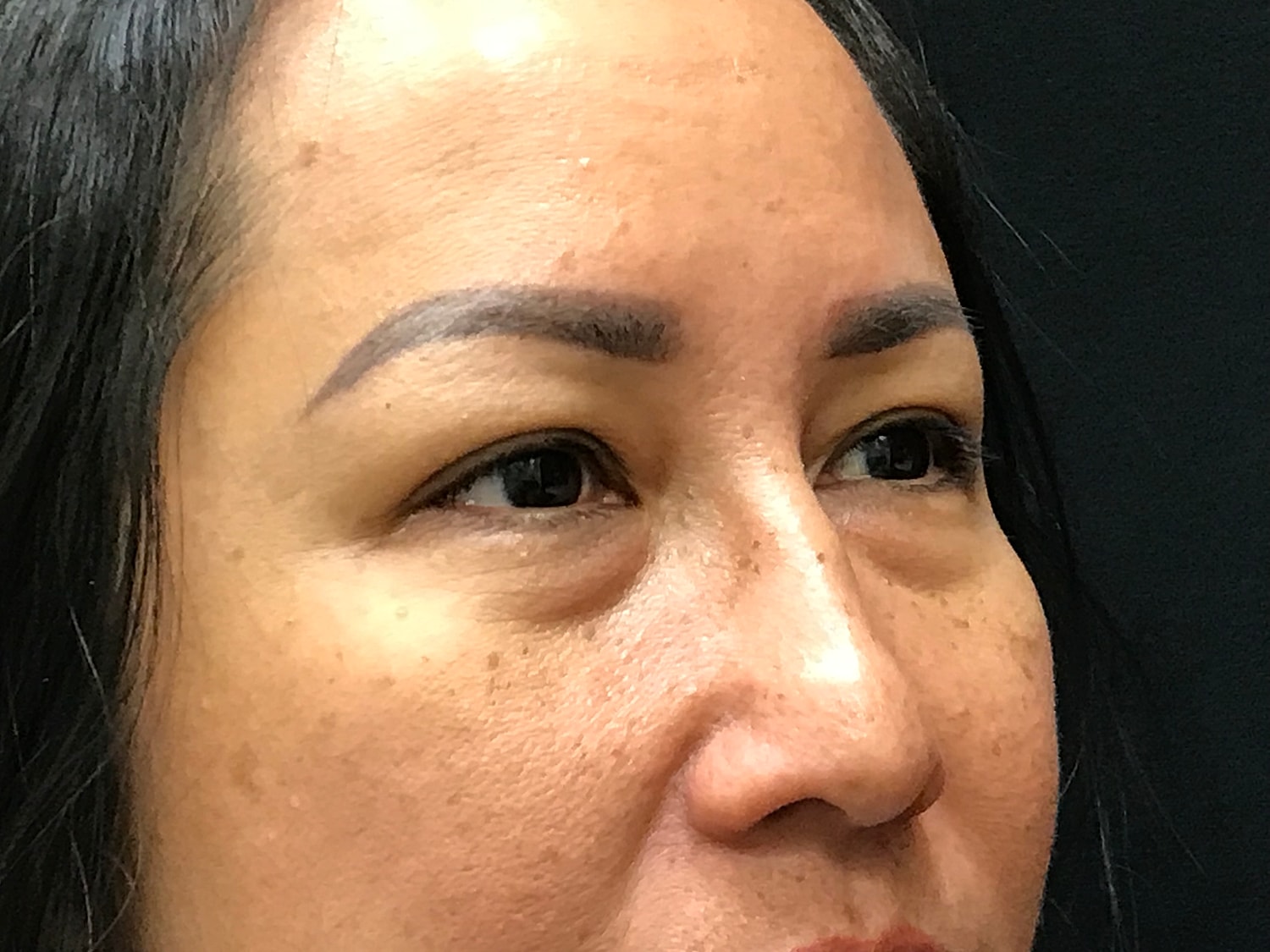 Blephroplasty [.block]Gallery[] Before & After