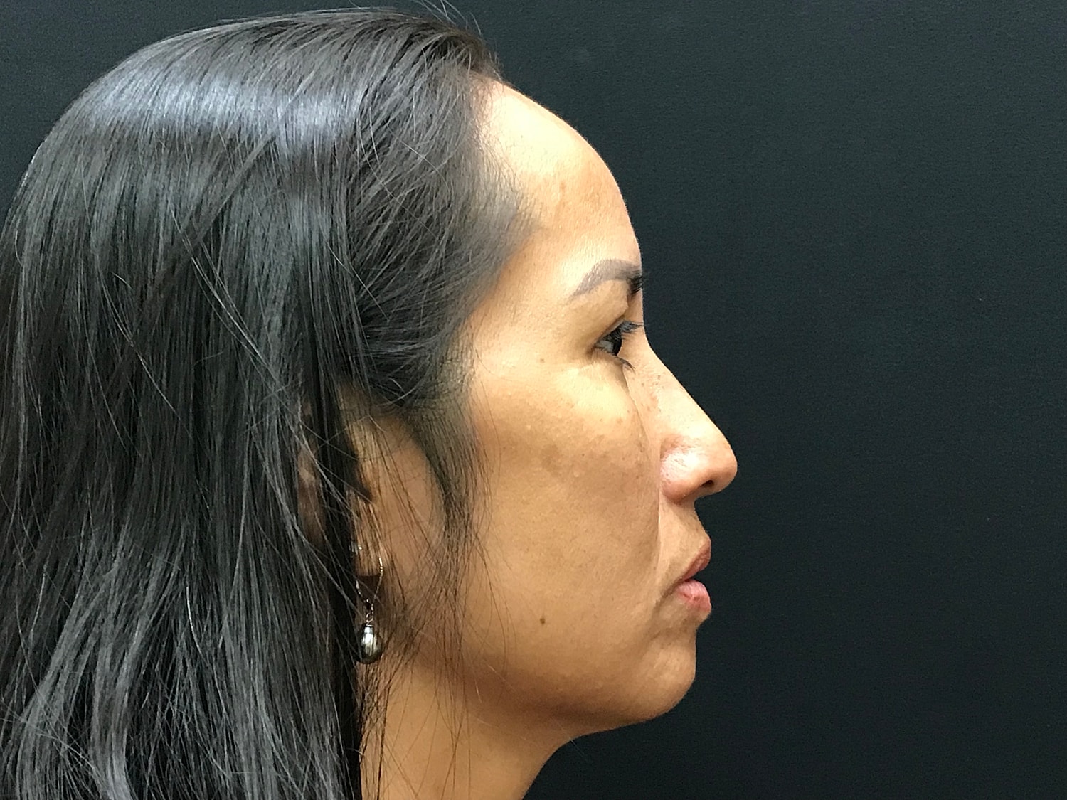 Blephroplasty [.block]Gallery[] Before & After