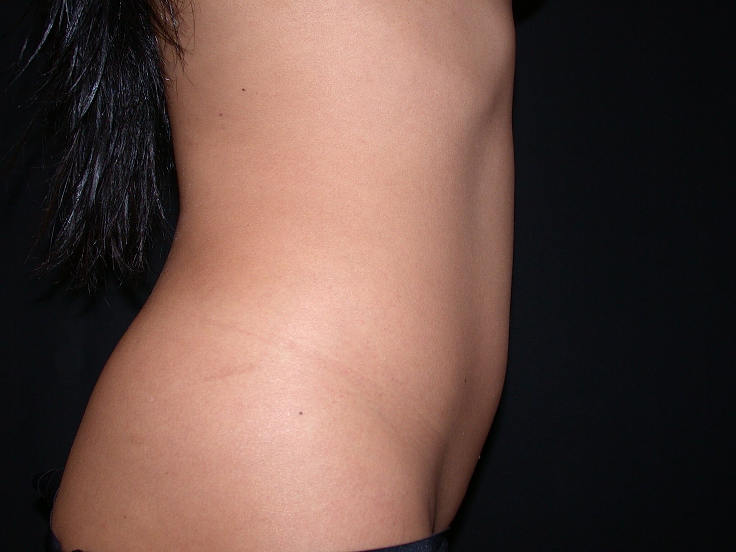 Liposuction Before & After