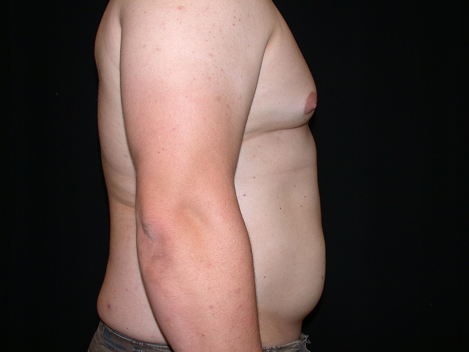 Liposuction Before & After