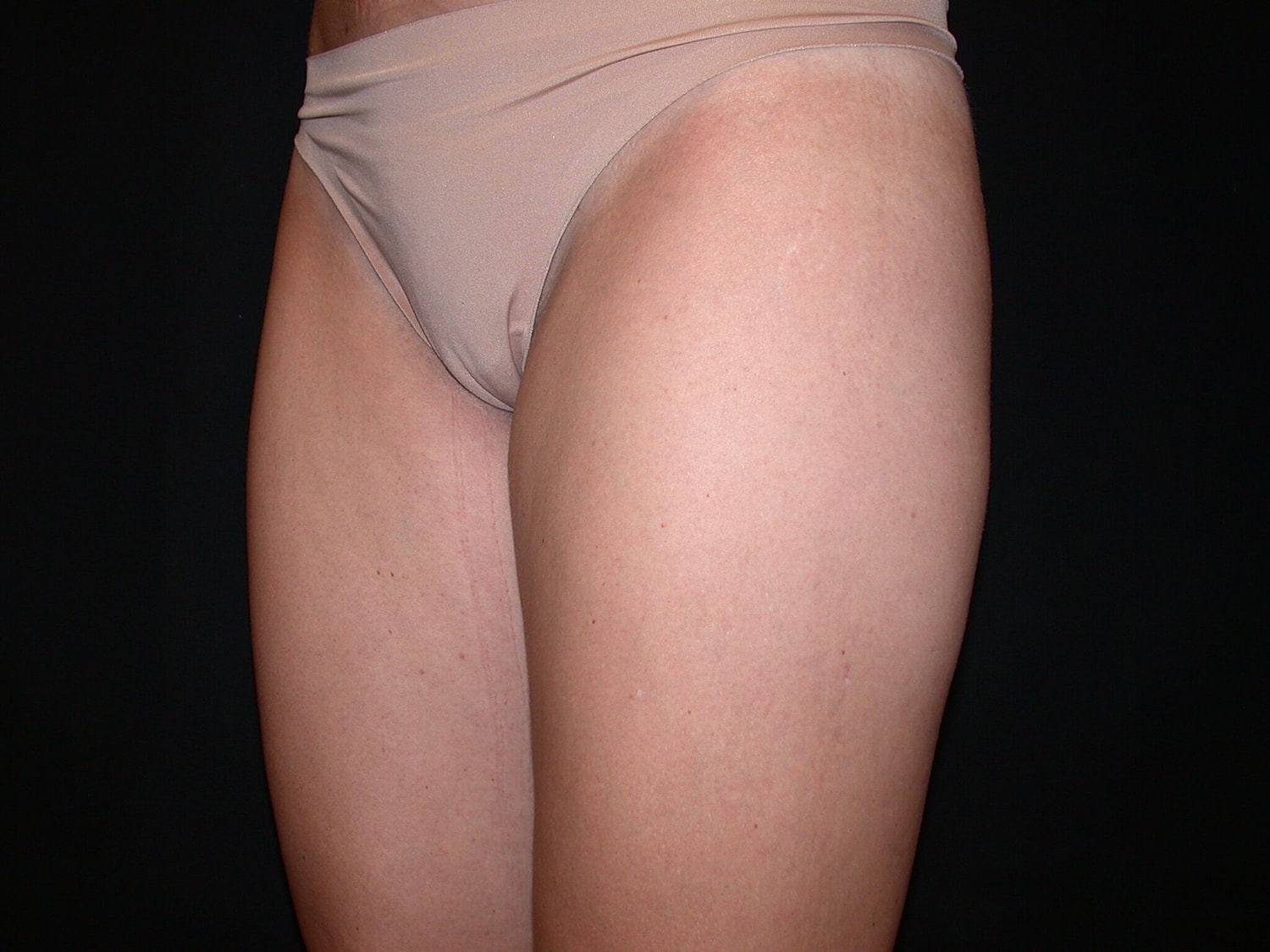 Liposuction Before & After