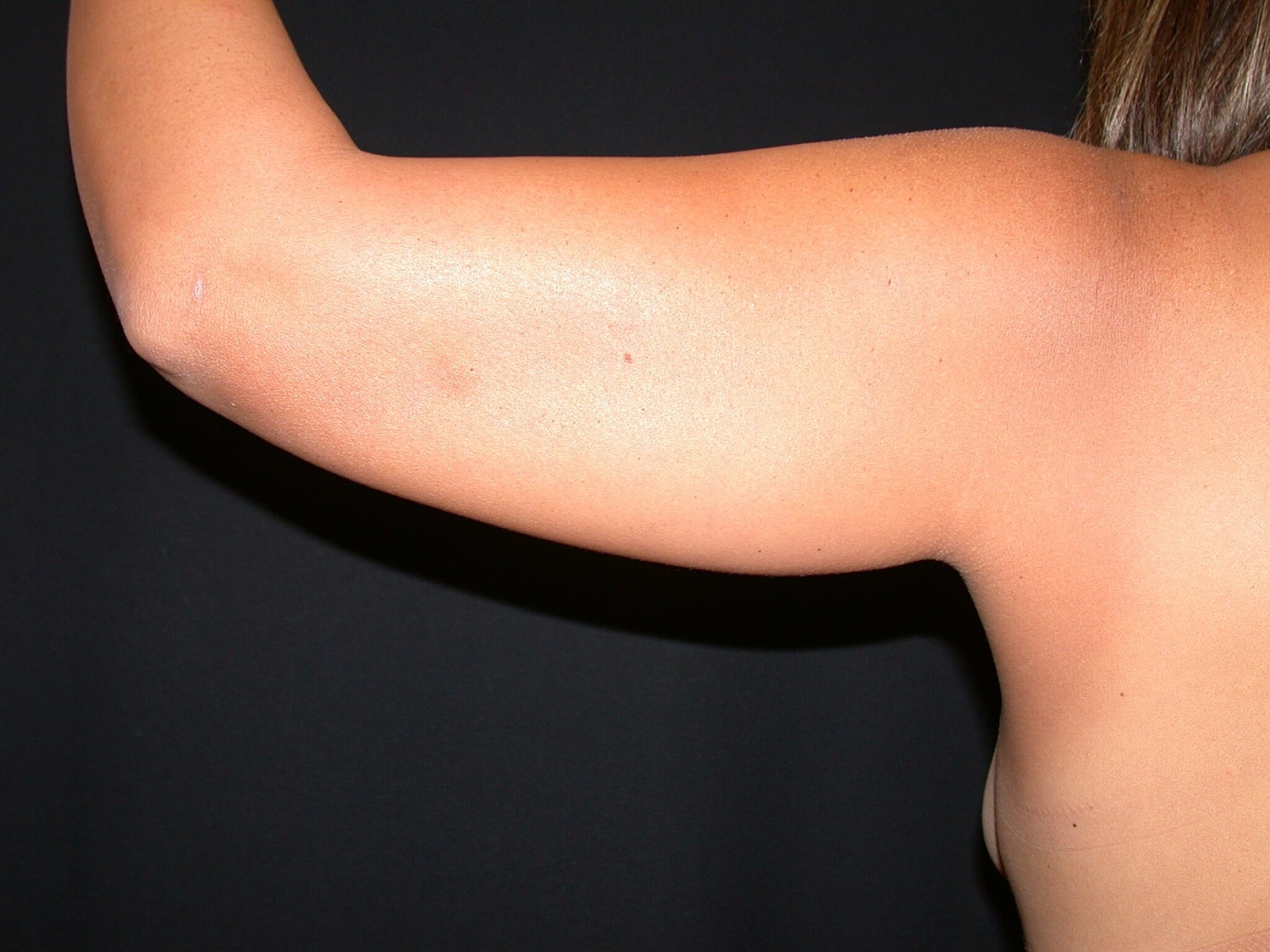 Liposuction Before & After