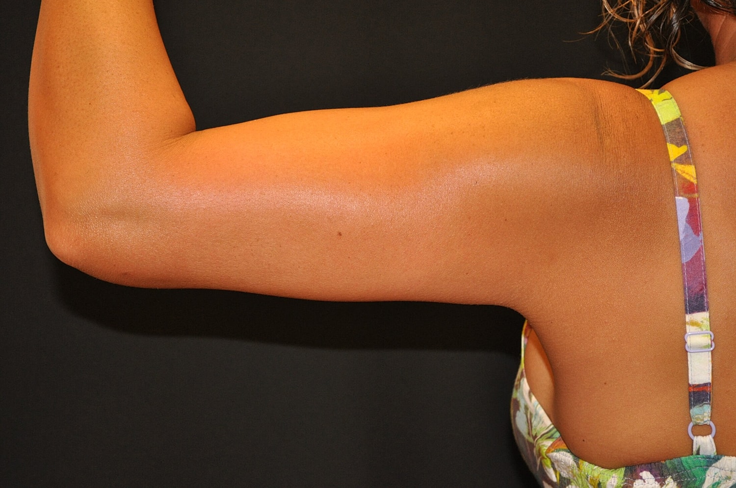 Liposuction Before & After