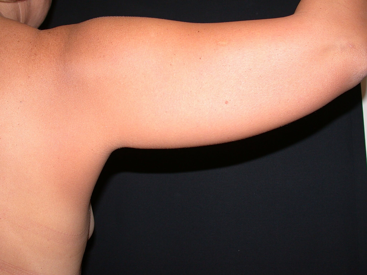 Liposuction Before & After