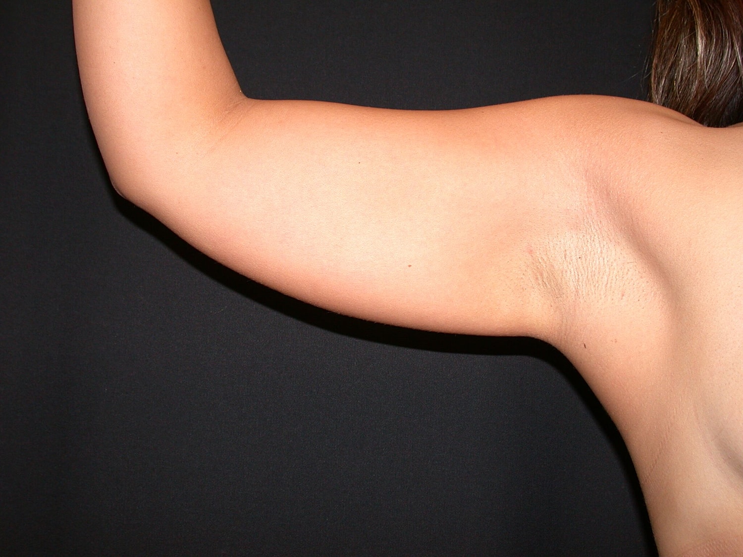 Liposuction Before & After