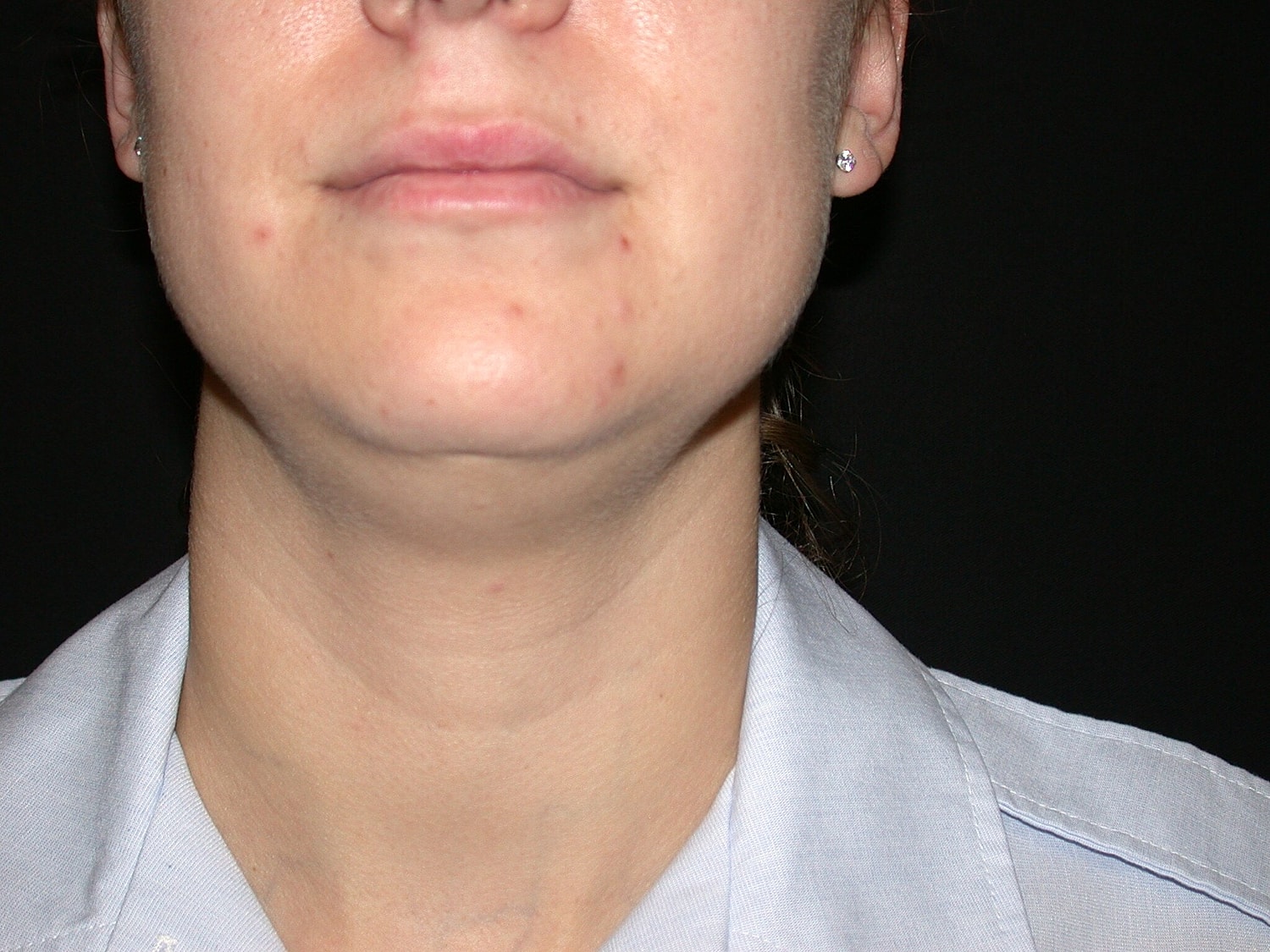 Liposuction Before & After