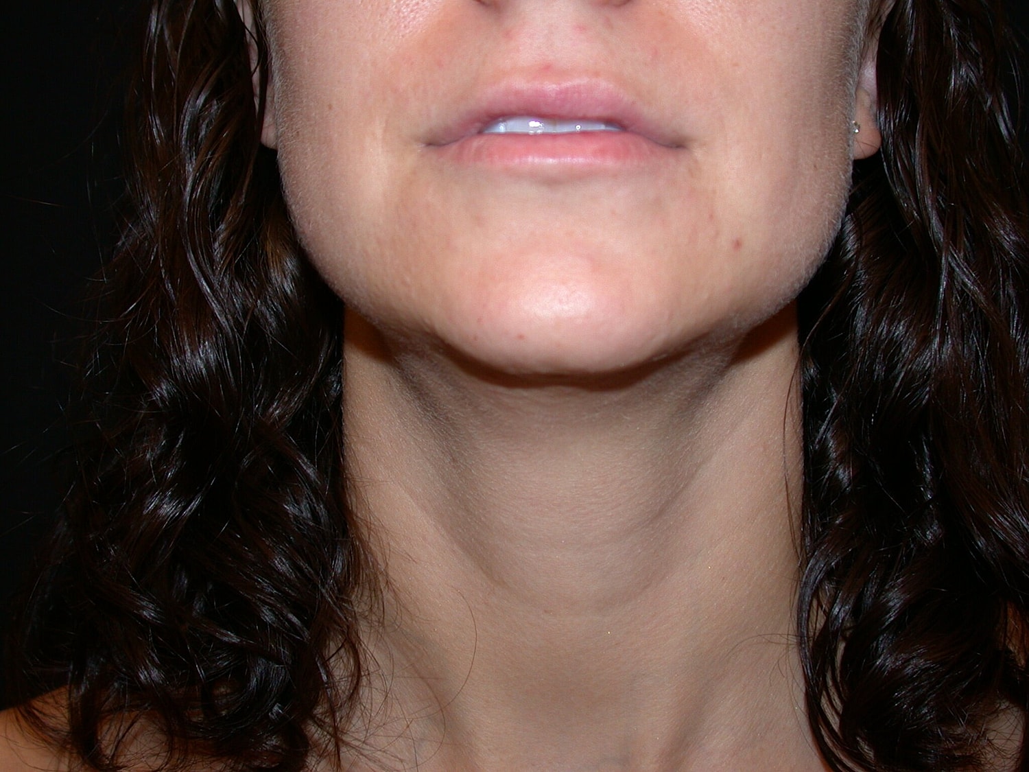 Liposuction Before & After