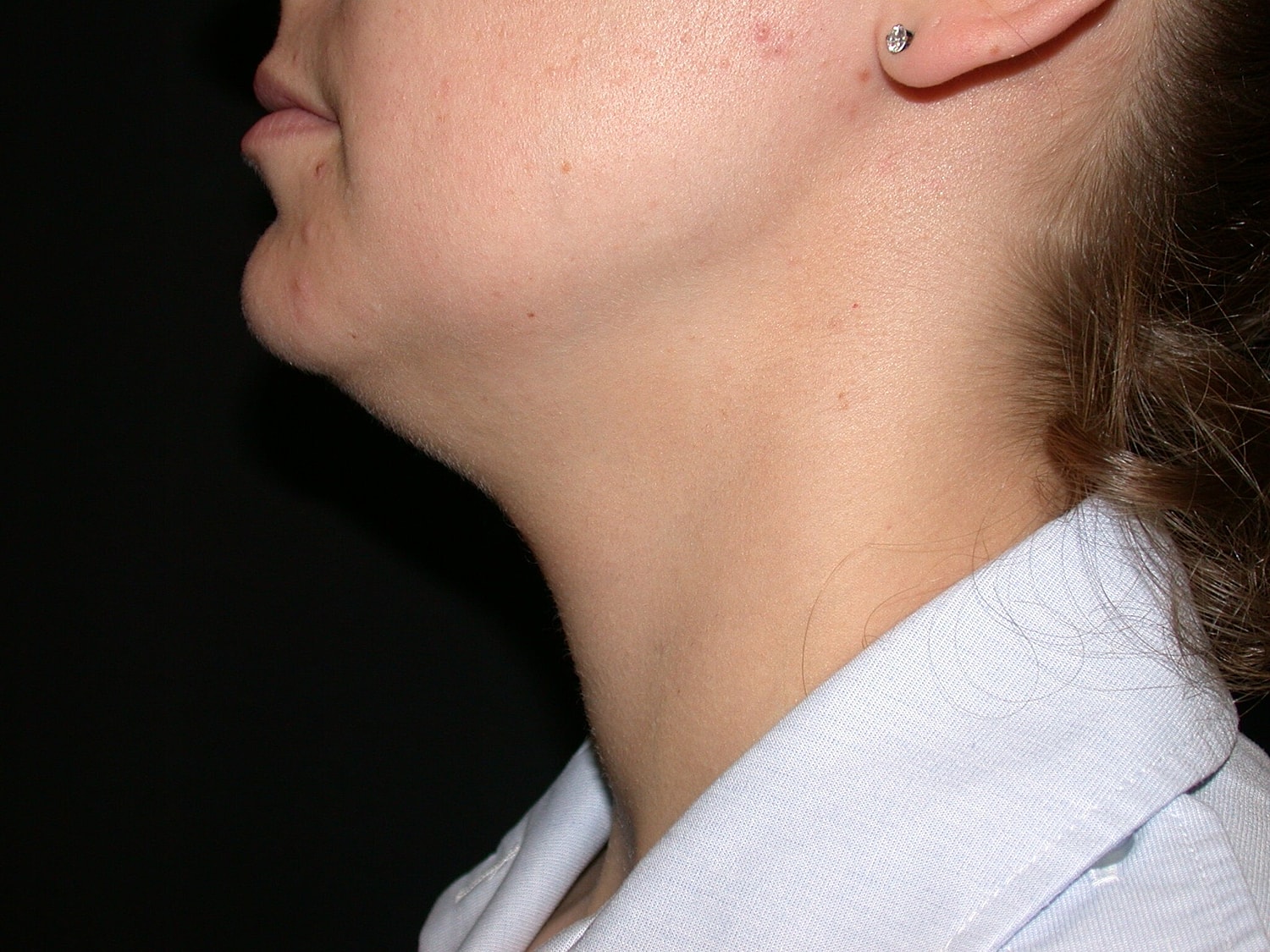 Liposuction Before & After