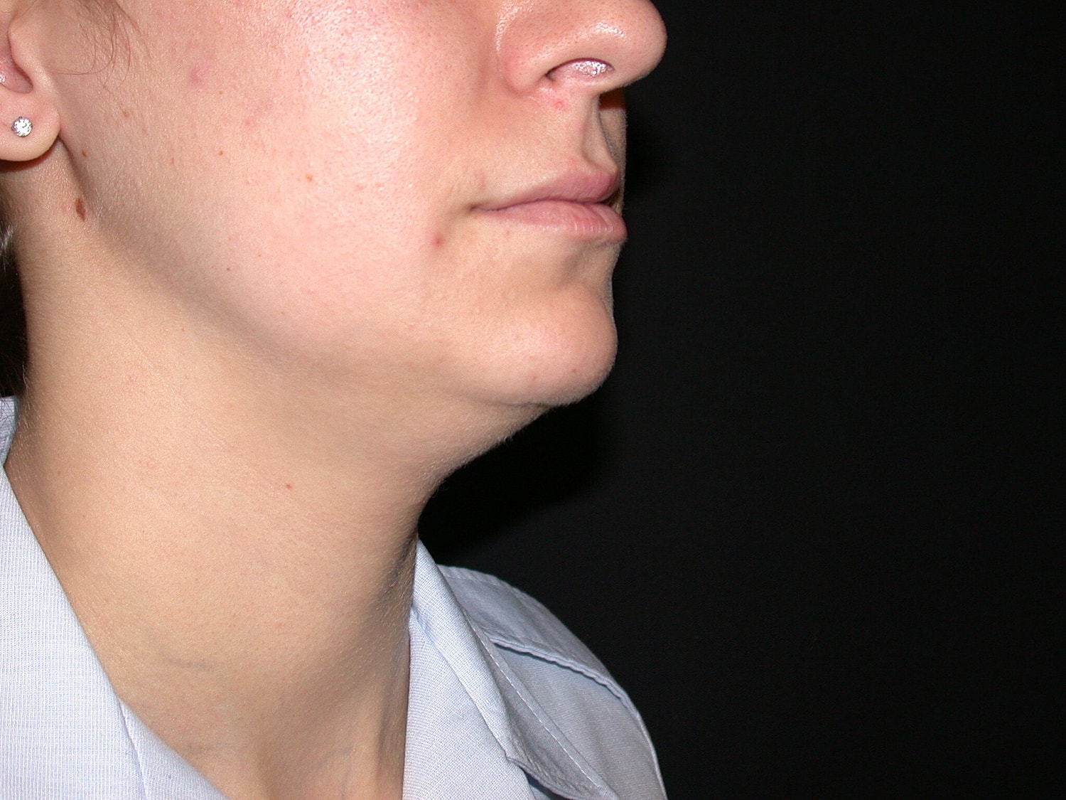 Liposuction Before & After