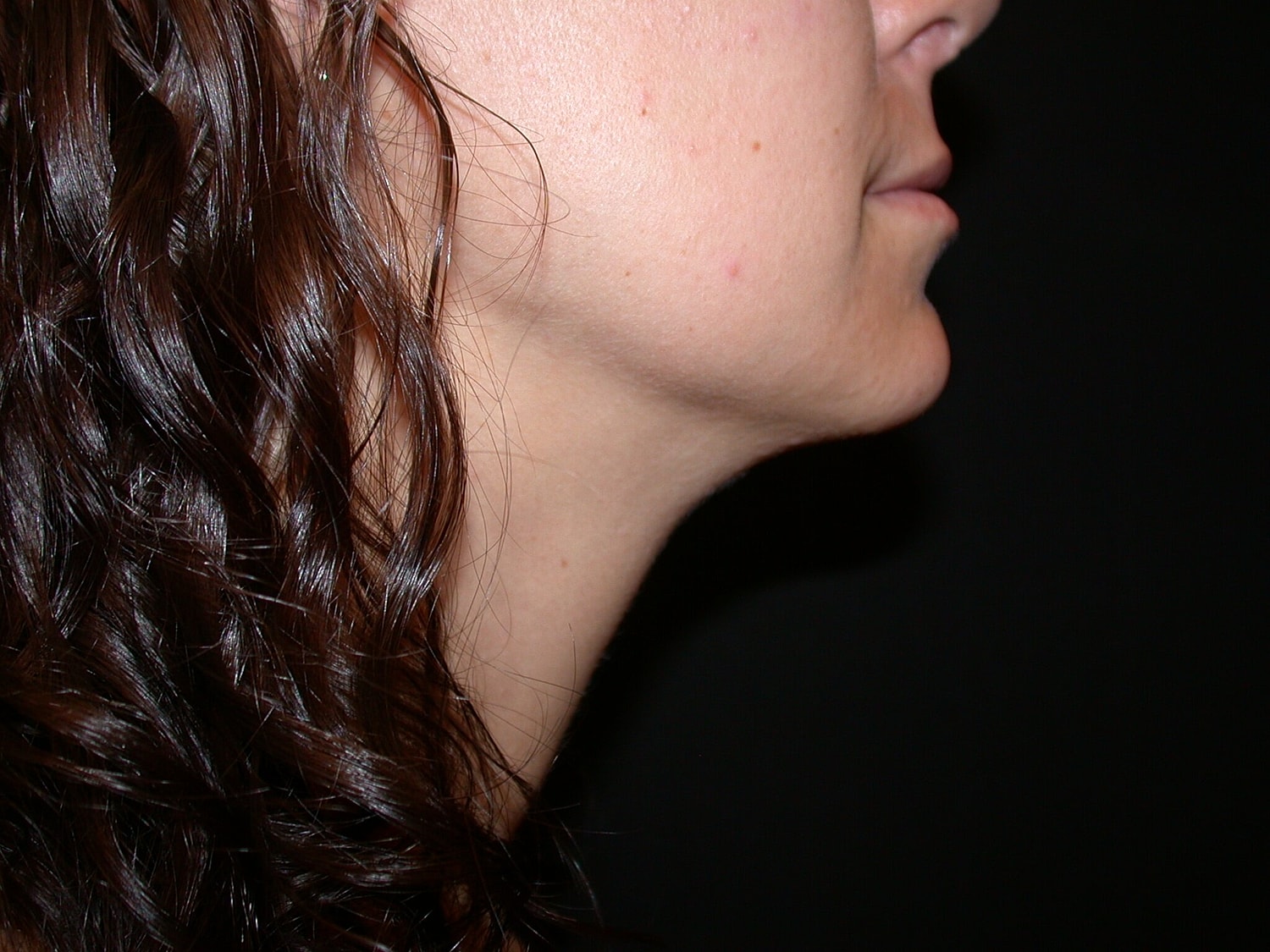 Liposuction Before & After