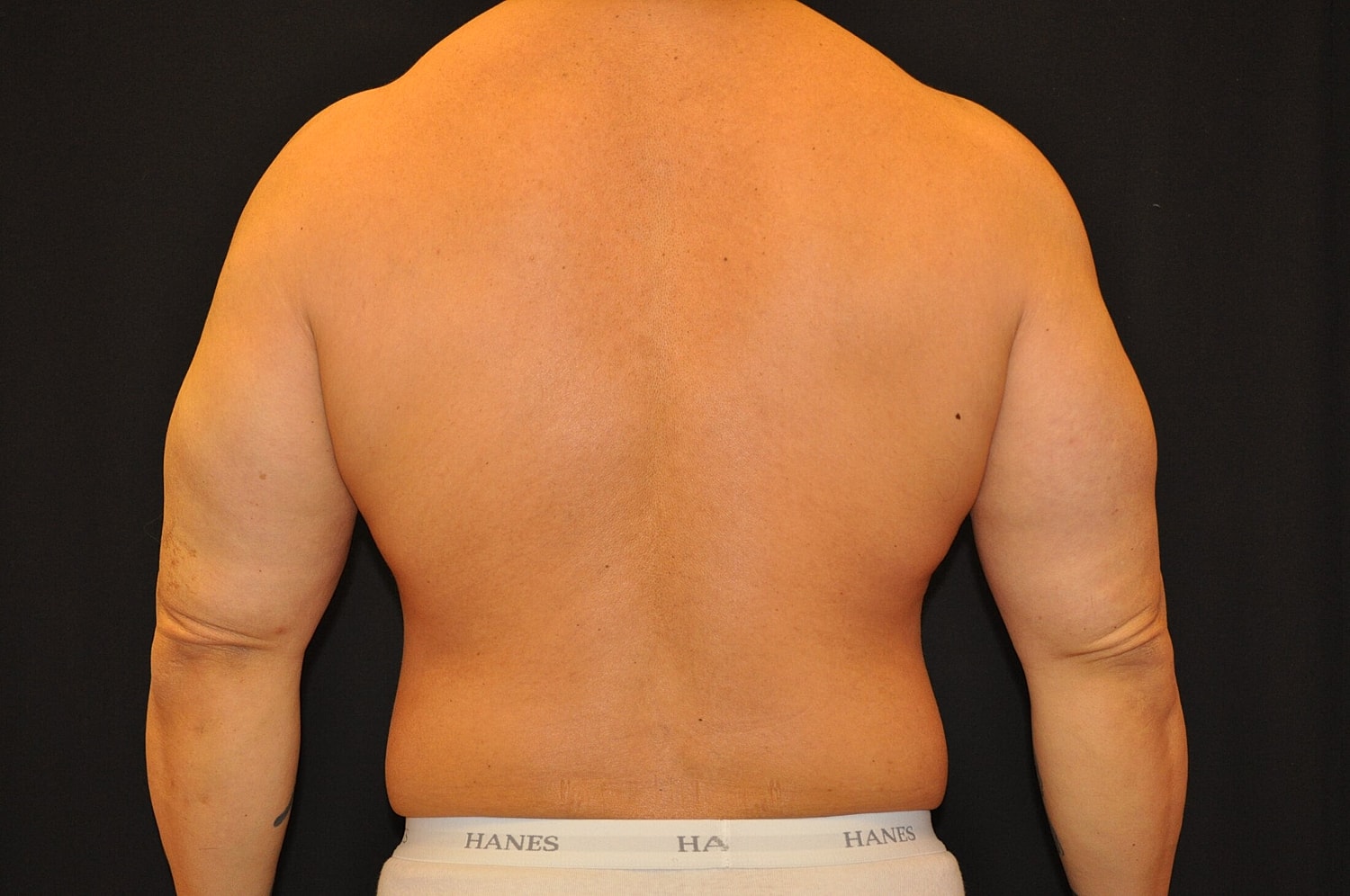 Liposuction Before & After