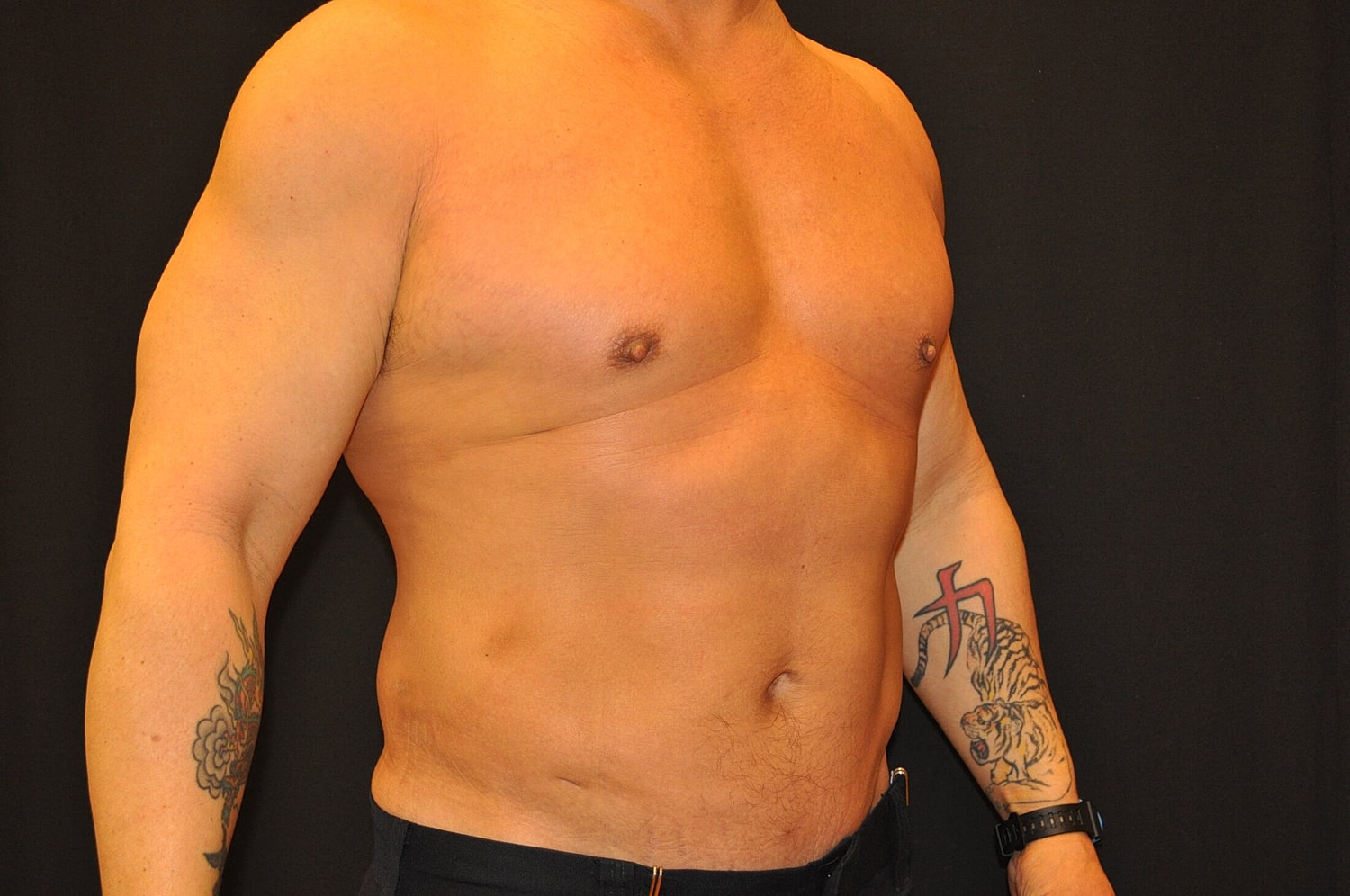 Liposuction Before & After