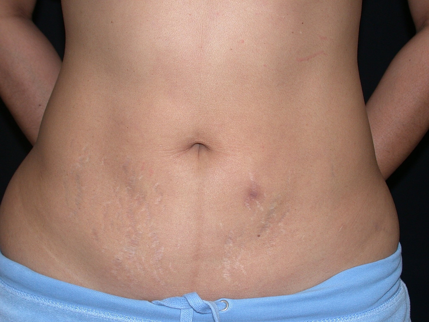 Liposuction Before & After