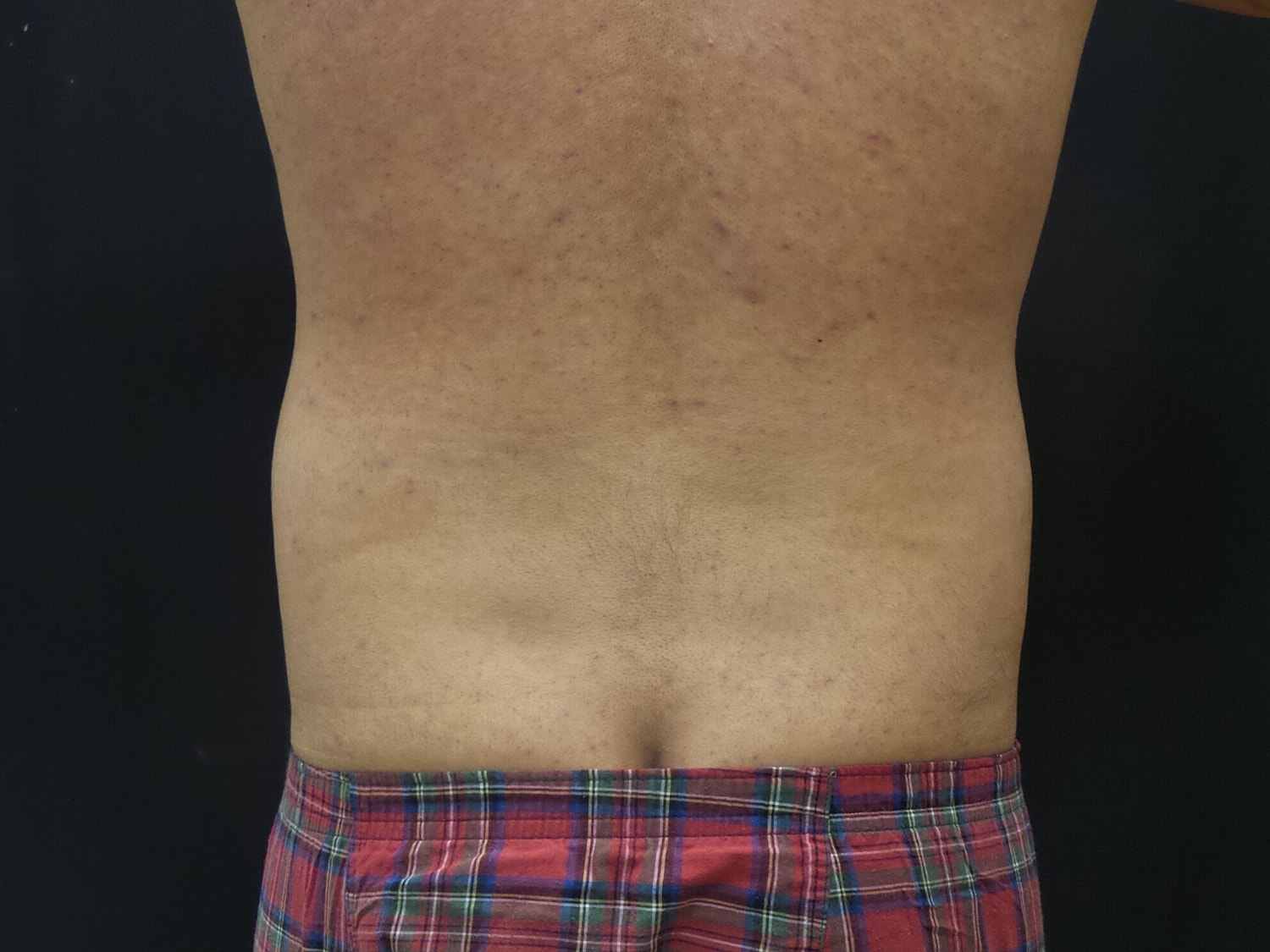 Liposuction Before & After