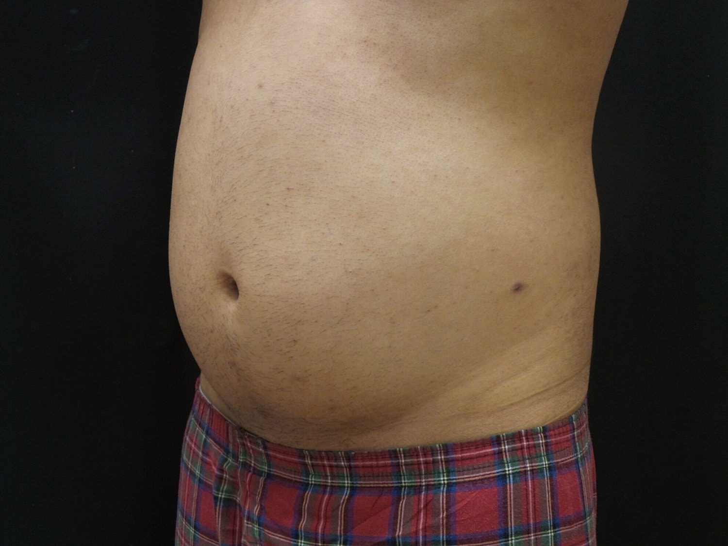 Liposuction Before & After