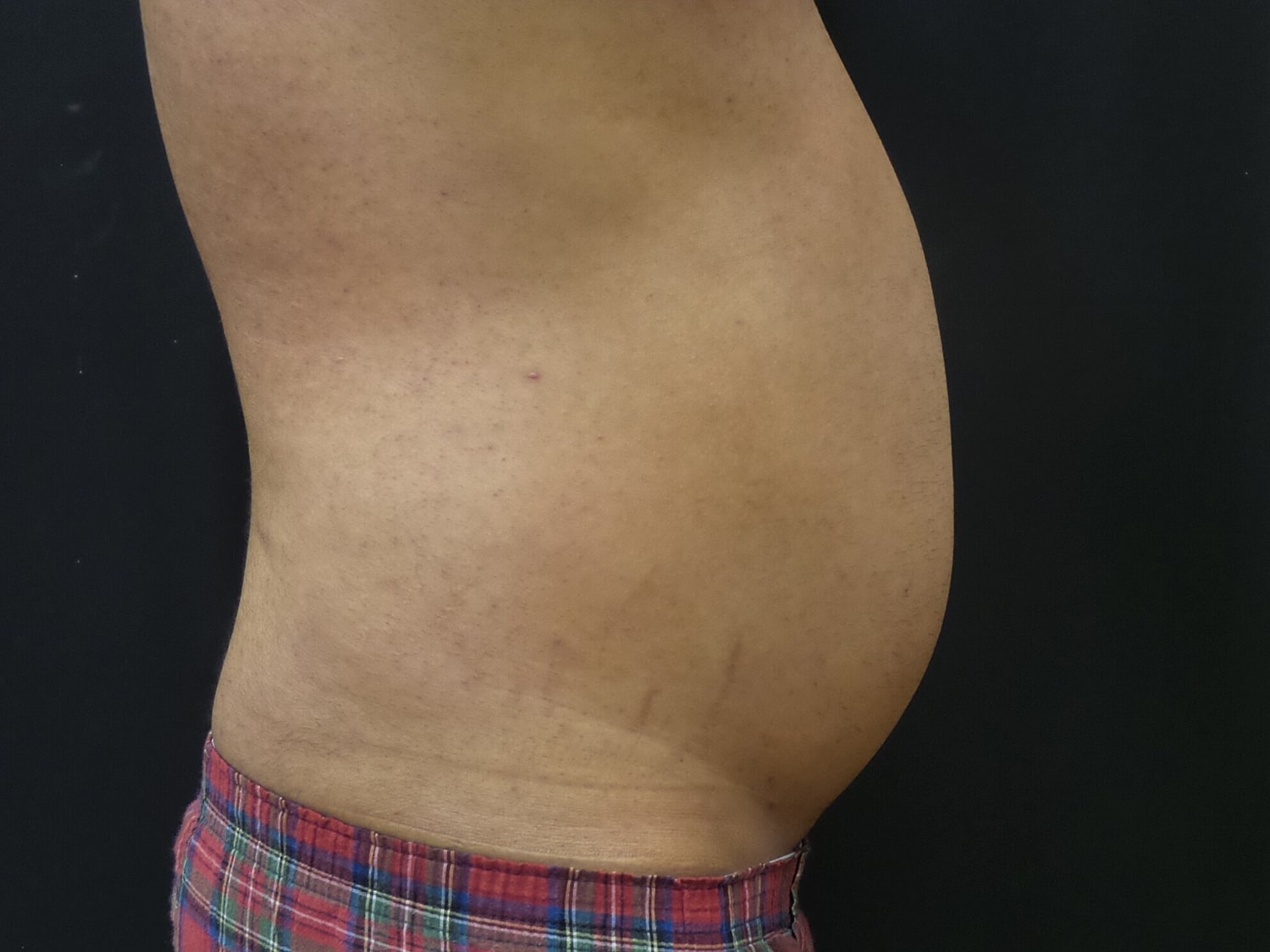 Liposuction Before & After