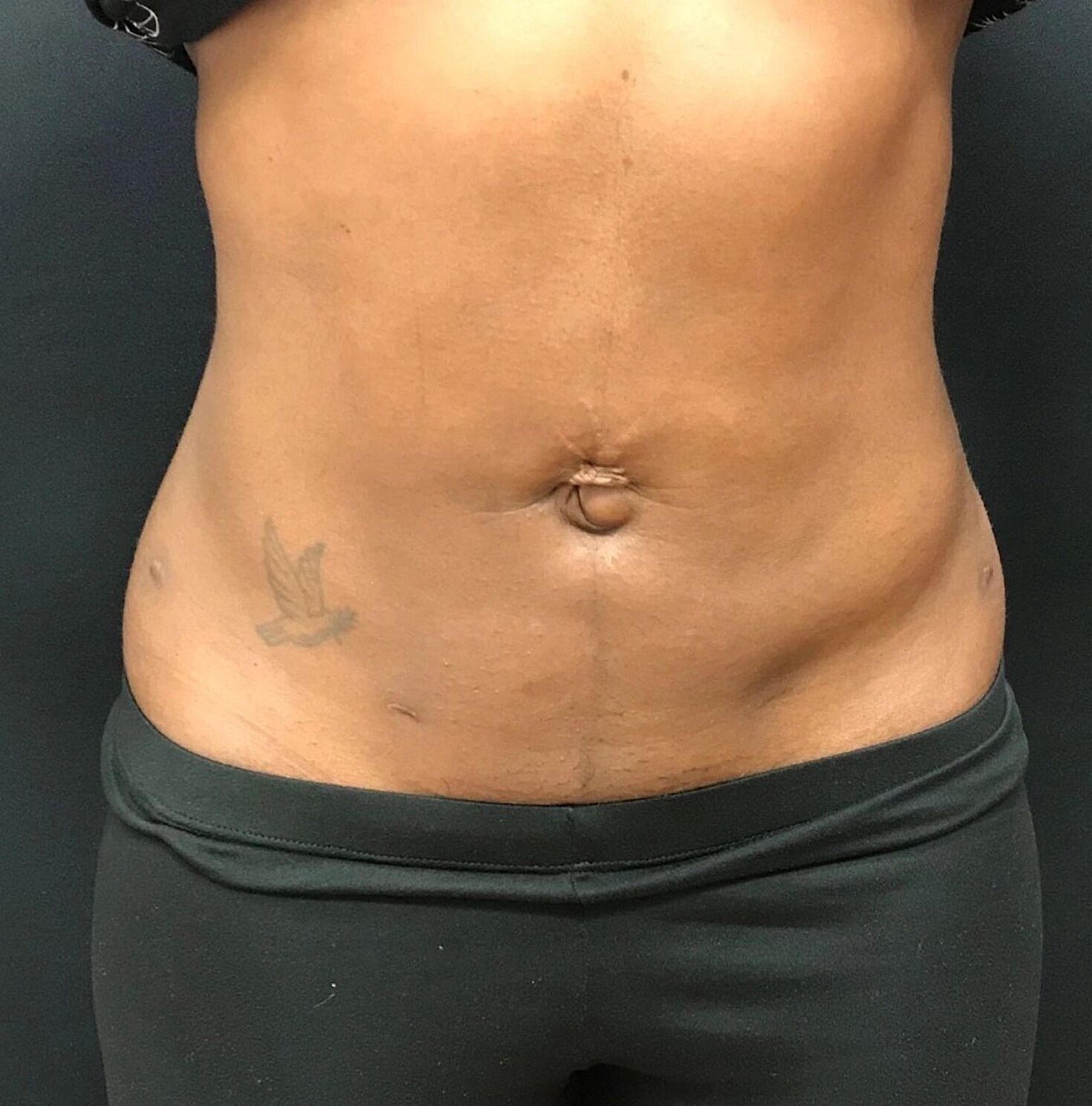 Liposuction Before & After