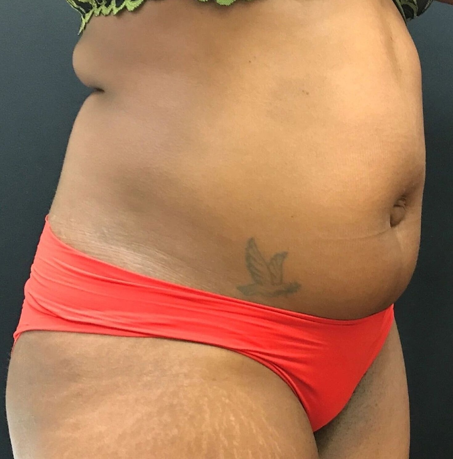 Liposuction Before & After