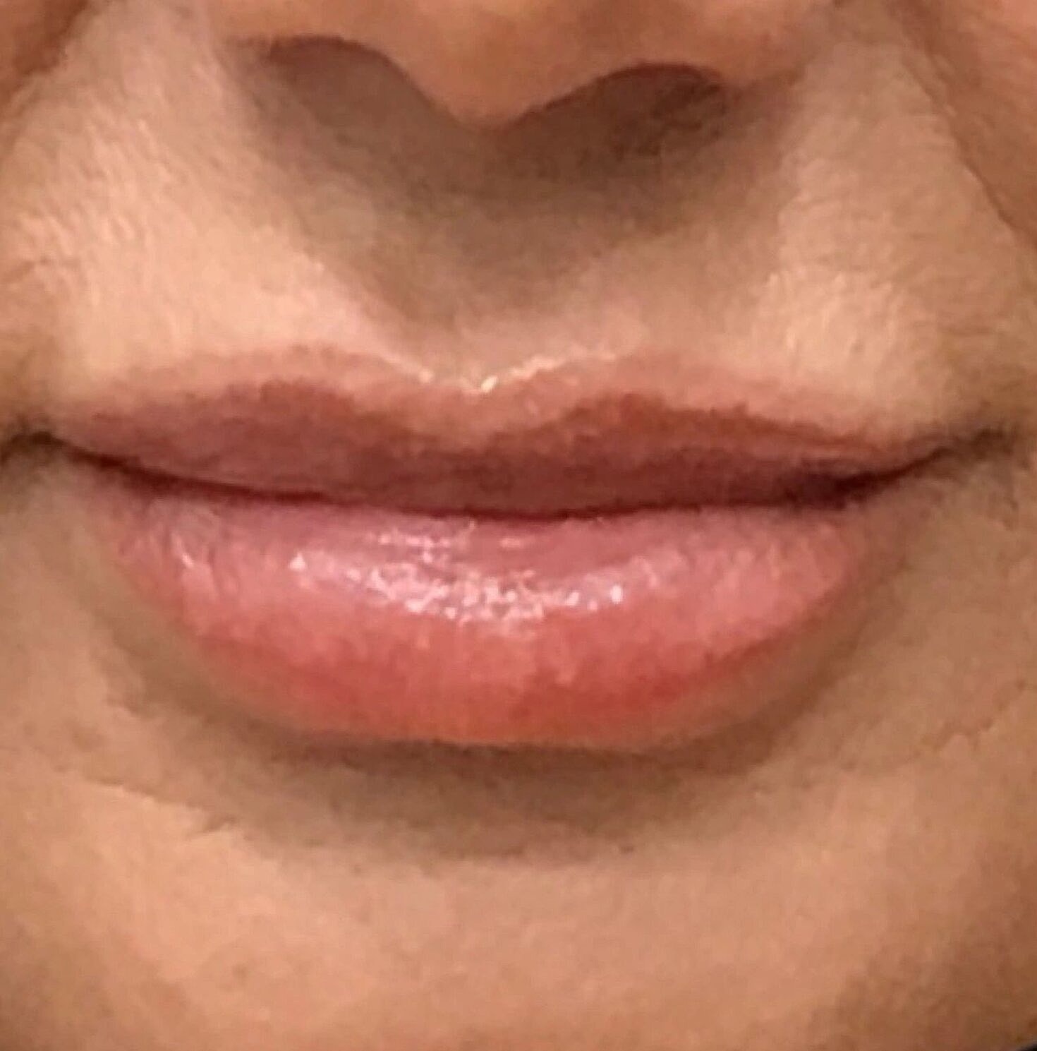 Lip Lift Before & After