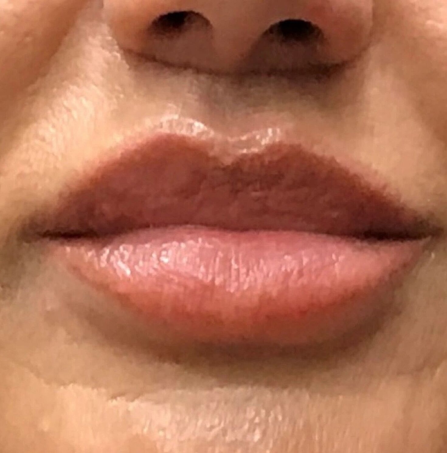Lip Lift Before & After