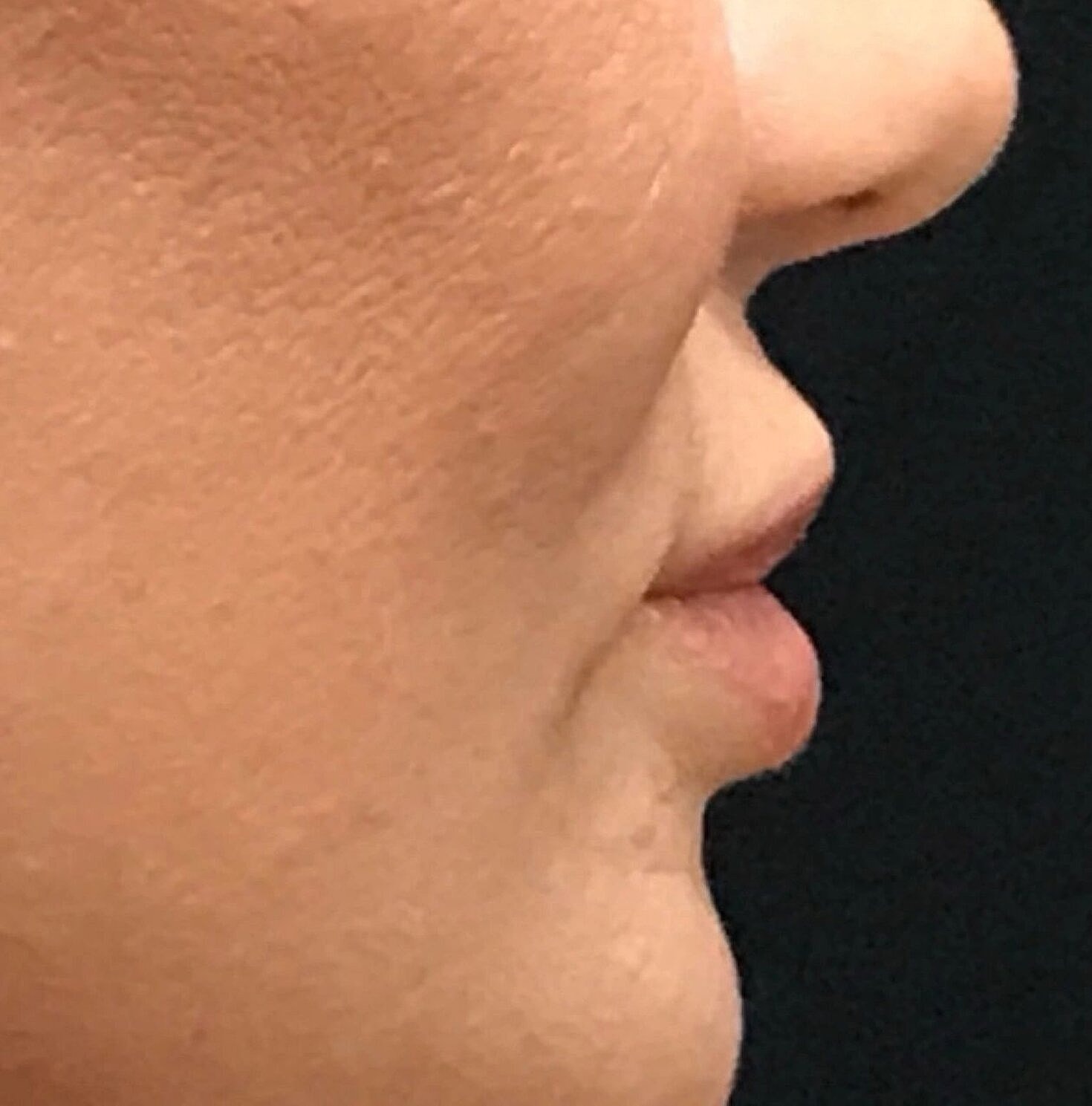 Lip Lift Before & After