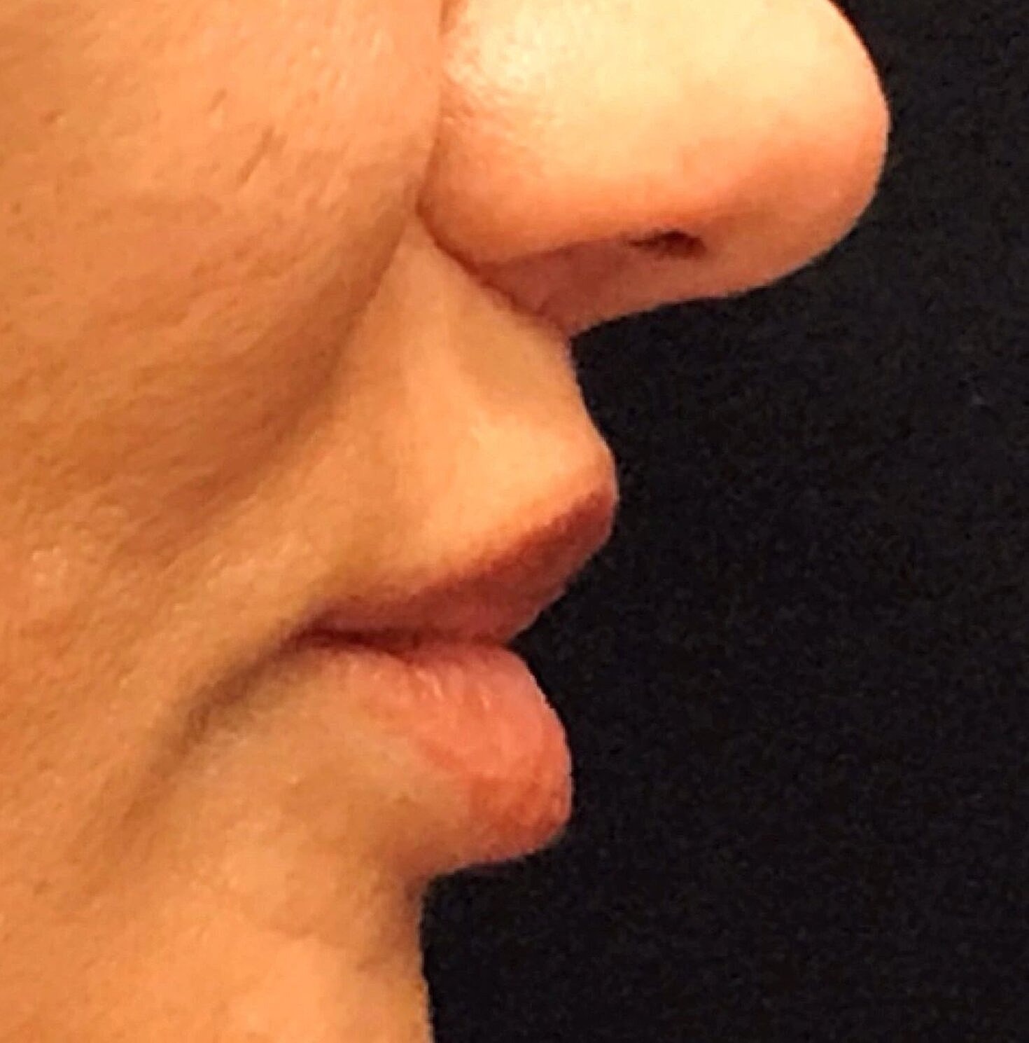 Lip Lift Before & After