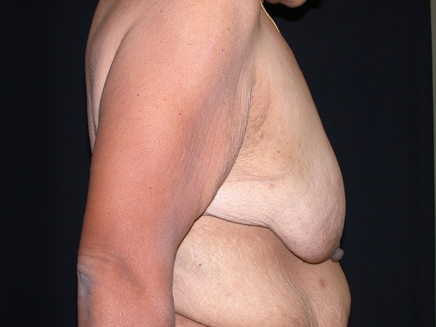 Breast Lift Before & After