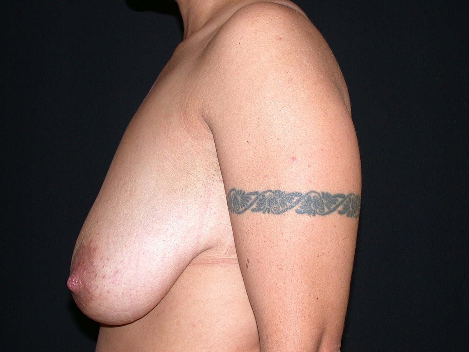 Breast Lift Before & After